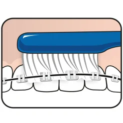 TePe Implantaat en Orthodontieborstel